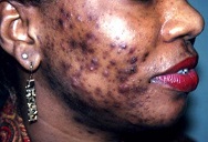 acne-vulgaris-pim...e003-1-1-45162ca